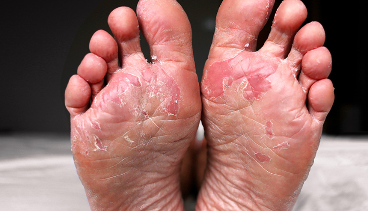 How to Tell if Your Nail Has Fungus (and What to Do About It)